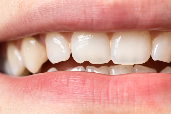 Why It Is Important to Repair a Chipped Tooth - Sandston